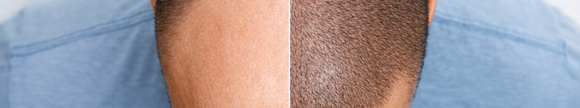 Injerto Capilar Zaragoza